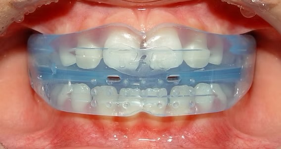 Aparelho miofuncional Myobrace em uso